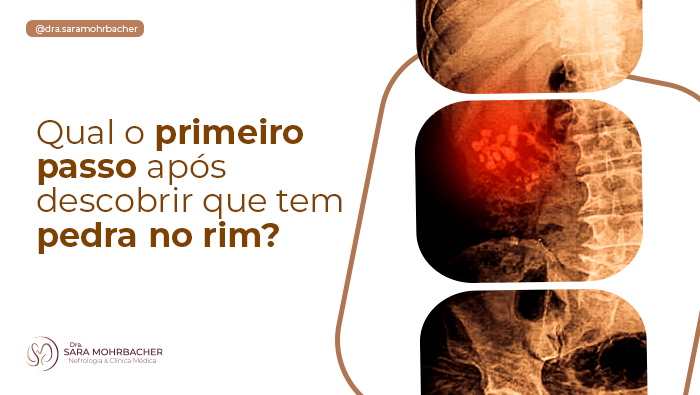 Qual o primeiro passo após descobrir que tem pedra no rim Dra Sara