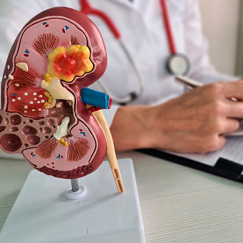Mão com luva azul segura um modelo anatômico de rim humano com inflamação, enquanto médico escreve em um prontuário ao fundo.