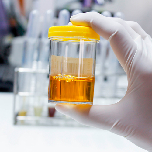 Mão com luva segurando frasco de exame de urina amarelo, em ambiente de laboratório com tubos ao fundo.