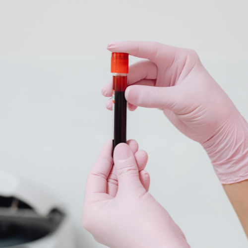 Mãos com luvas segurando um tubo de coleta com amostra de sangue, em ambiente clínico, simbolizando exame laboratorial e avaliação diagnóstica.