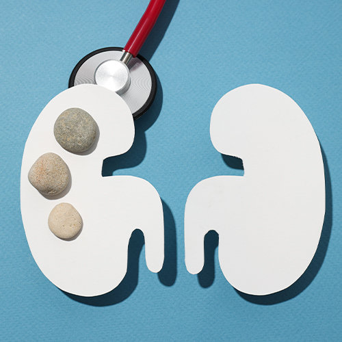 Ilustração de rins com pedras sobre um deles e estetoscópio ao lado, representando cálculo renal e avaliação médica.