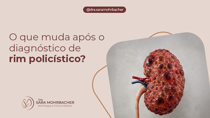 O que muda após o diagnóstico de rim policístico? 1 Ilustração anatômica de rim policístico com múltiplos cistos em destaque, representando alterações estruturais causadas pela doença renal policística.